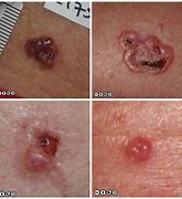 Image result for Basal Cell Carcinoma Cancer Symptoms