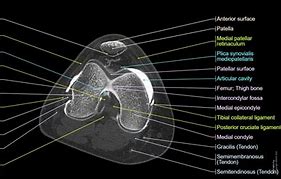 Image result for CT Knee Radiopaedia