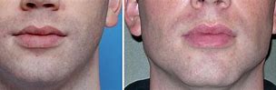 Image result for Pointy Chin Surgery