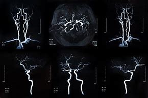 Image result for Migraine with Aura Stroke