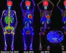 Image result for Osseous Metastatic Disease