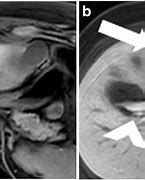 Image result for Biloma Ultrasound Images Post-Cholecystectomy