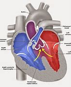 Image result for Right Ventricular Outflow Tract