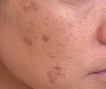 Image result for Black Spots On Skin Means