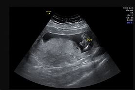 Image result for Male Baby Ultrasound