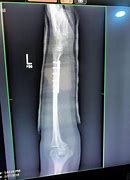 Image result for A Broken Bone