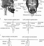 Image result for Mid Coronal Plane