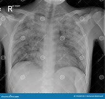 Image result for Chest X-ray of TB