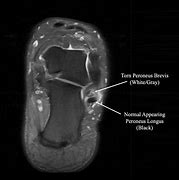 Image result for Peroneal Retinaculum MRI