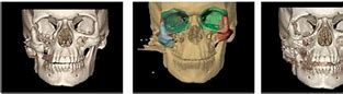 Image result for Craniofacial Surgery