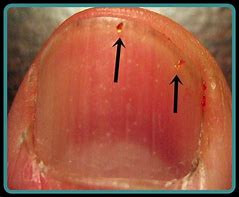 Image result for Blood Mites