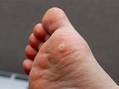 Image result for Flat Warts On Eyelids