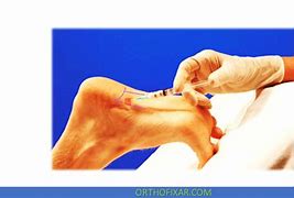 Image result for Plantar Fascia Steroid Injection