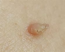 Image result for Filiform Wart On Finger