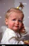 Image result for Thorax Girl Pox