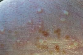 Image result for Psoriatic Pustules