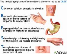 Image result for Scleroderma Microscopic