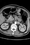 Image result for Cancer De Colon Tac