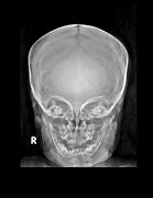 Image result for Skull Fracture