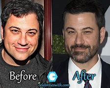 Image result for Jimmy Kimmel Before and After