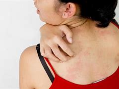 Image result for Diabetic Rash