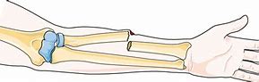 Image result for Bone Fracture Cartoon