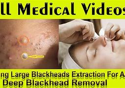 Image result for Skin Peels Blackhead Removal