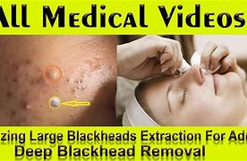 Image result for Blackhead Removal Before and After