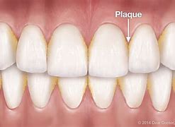 Image result for How to Avoid Plaque On Teeth