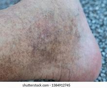 Image result for Dark Pigmentation On Legs