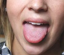 Image result for Open Sore On Tongue