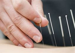 Image result for Acupuncture