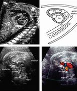 Image result for Abnormal Fetal Heart Ultrasound