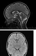 Image result for Ataxia MRI