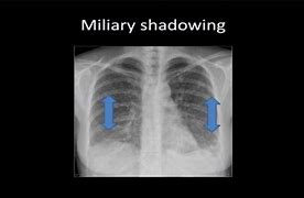 Image result for Miliary Tuberculosis Chest X-ray