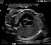 Image result for Rvot and LVOT Fetal Ultrasound Images Colour