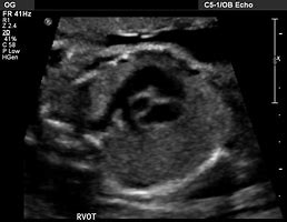 Image result for LVOT Rvot Ultrasound