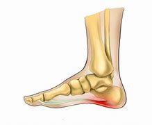 Image result for Plantarfasziitis