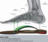 Image result for Arch Collaps Feet