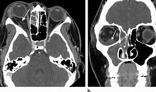 Image result for Subperiosteal Abscess Orbital Cellulitis