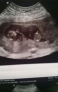 Image result for 11 Week Ultrasound Twins