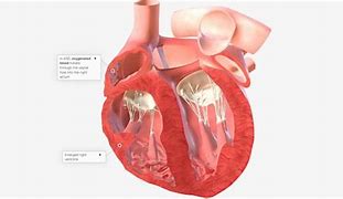 Image result for Atrial Septal Defect Blood Flow