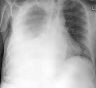 Image result for Pleural Effusion Images