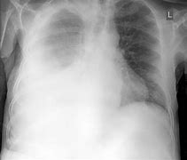 Image result for Pleural Infection