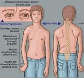 Image result for Brachial Plexus Injury