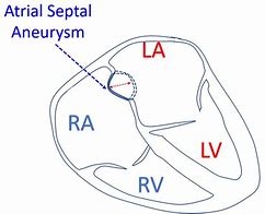 Image result for Septal Aneurysm