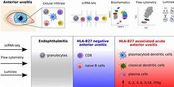 Image result for HLA Gene Uveitis