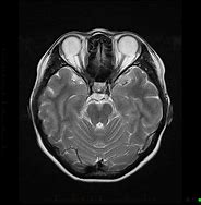 Image result for Brain MRI Angiogram