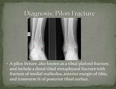 Image result for Surgical Approach of Pilon Fracture