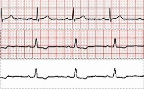 Image result for Heart Failure Electrocardiogram